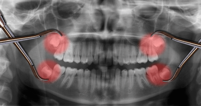 xray of patients wisdom teeth